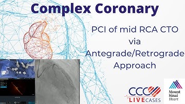 PCI of mid RCA CTO via Antegrade/Retrograde Approach - December 2022