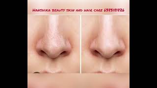 Open Pores Treatment And Black Head Treatment At Hanshika
