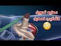 شاهد عملية تحويل العضو الذكري إلى أنثوي جراحة تحول الرجل لأمرأة Surgery To Convert Penis To Vagina