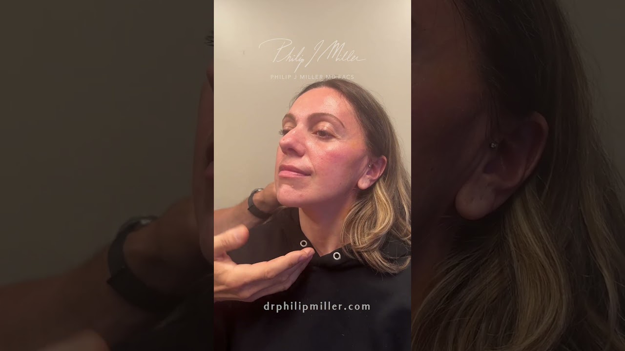 6 Days Post Op MicroLift-Face!