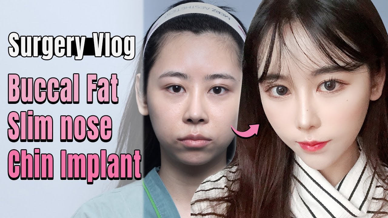 [SUB] BUCCAL FAT REMOVAL, NOSE JOB, FAT GRAFTING VLOG before and
