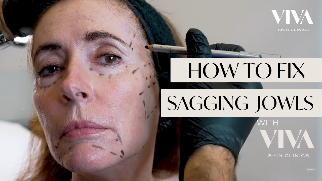 How To Fix Sagging Jowls Dermal Filler Injections Viva 2023 Youtube