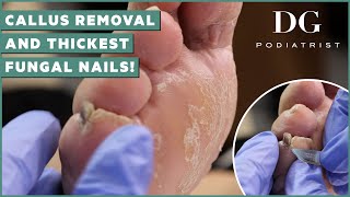 Callus removal from feet and thick toenails cutting treatment | DG Podiatrist: The Foot Scraper