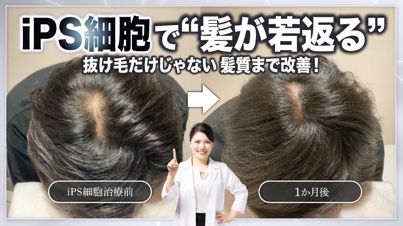 【最新再生医療】iPS細胞が髪を再生!? 発毛＋髪質改善のW効果がスゴい！