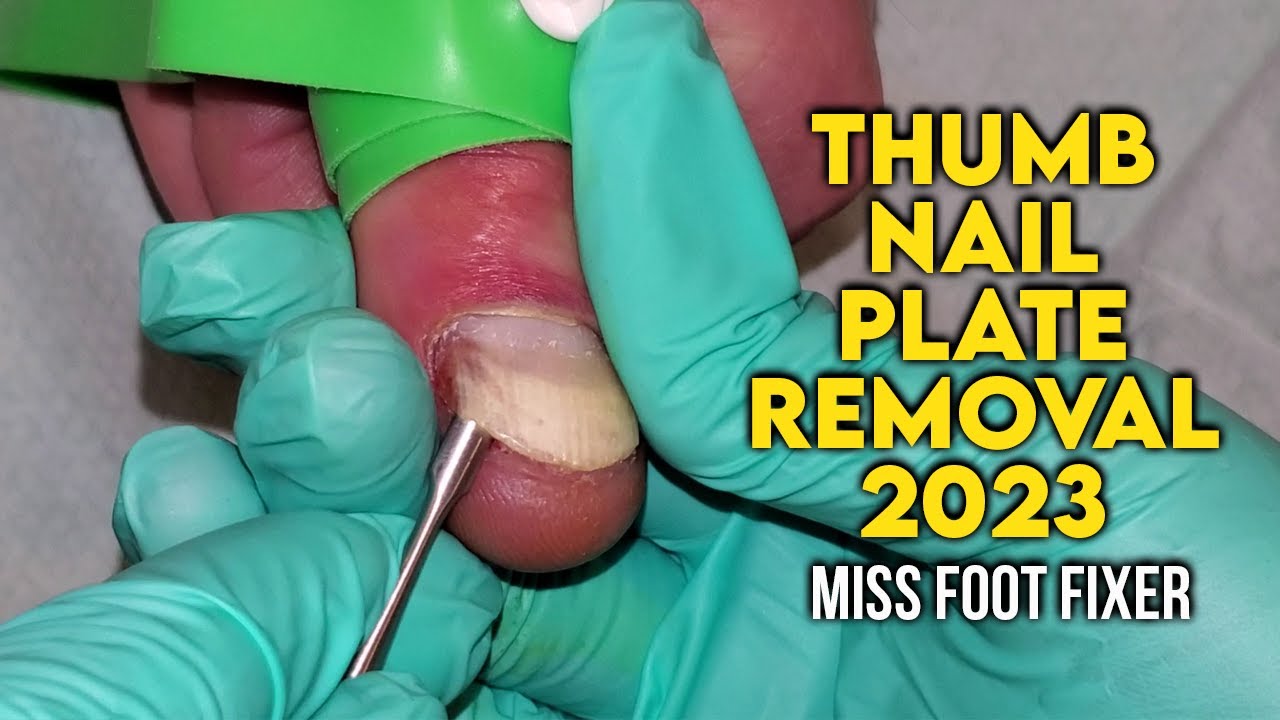 Permanent Toenail Removal: What You Need to Know - Footsteps: Christopher  Formanek, DPM