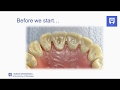 Endodontic Treatment of Single-Rooted Tooth: Part 2 🦷