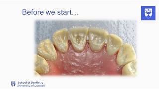 Endodontic treatment of the single rooted tooth. Part 2: Access cavity preparation