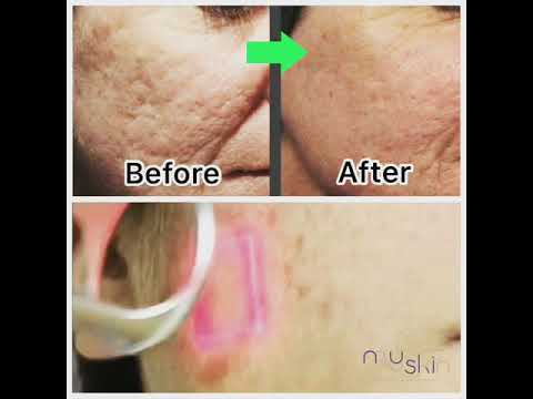Acne Scar treatment with Laser at My Skin Clinic Lahore