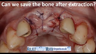 Extraction Site Before Dental Implant & PRF by Dr Kuljeet Singh Mehta-Periodontist 6,355 views 2 years ago 18 minutes