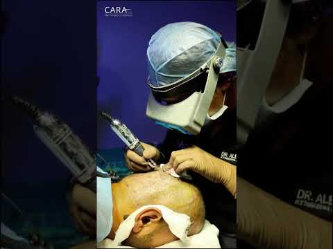 Don't get a hair transplant until you see this #hairtransplant #hairloss #fue