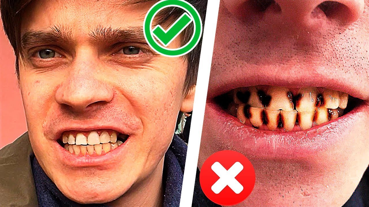 Лечение зубов видео до и после thumbnail