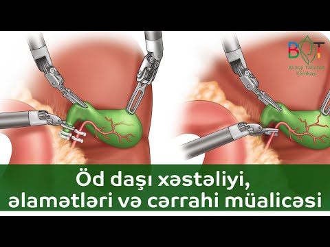 Öd daşı xəstəliyi, əlamətləri və cərrahi müalicəsi\