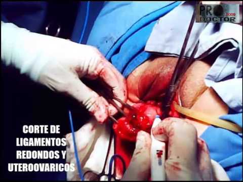 Histerectomía Total Vaginal
