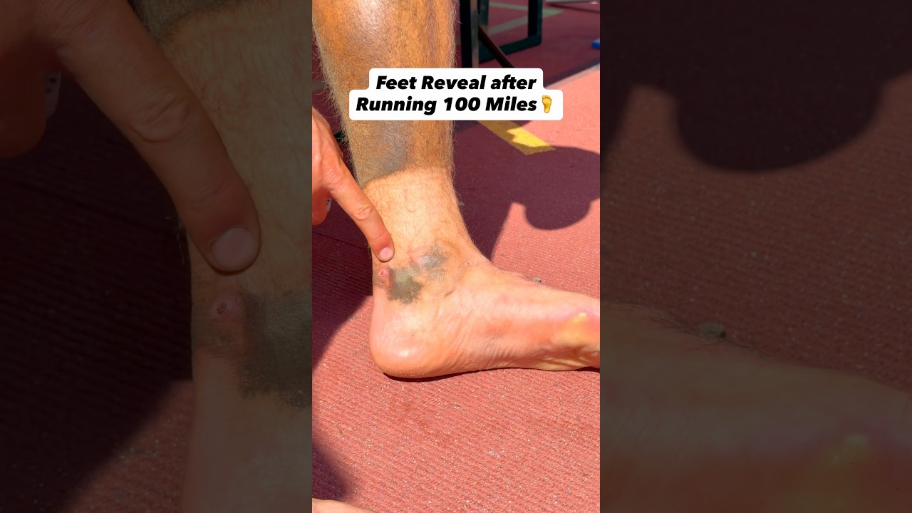 My Feet After Running 100 Miles