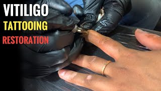 How cosmetic tattoos can be used to treat camouflage areas of vitiligo permanently? Ph no:9659959593