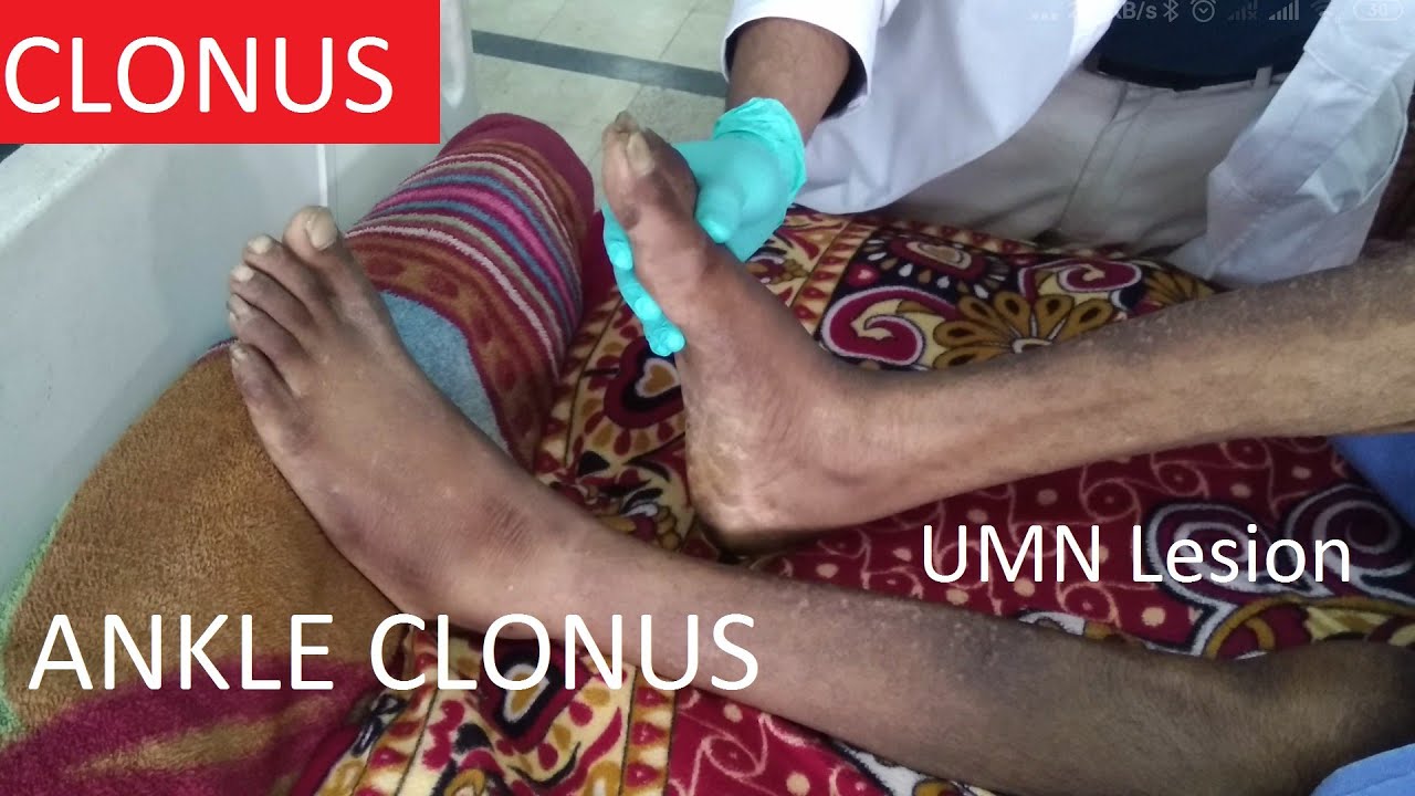 Clonus Ankle Clonus Upper Motor Neuron Lesion UMN lesion UMN
