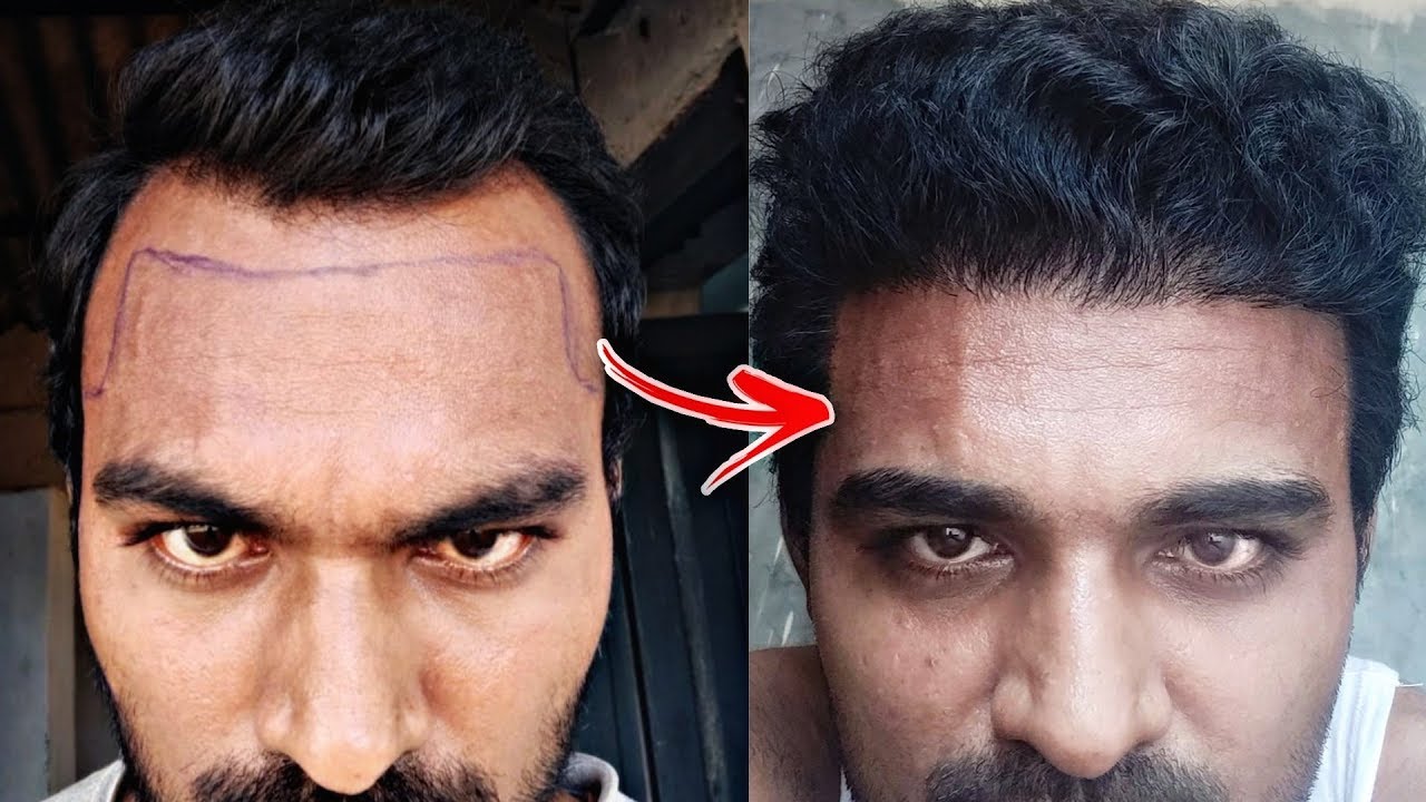 Hair Transplant Of The Year 2019 || 6 Month Hair Transplant Result ...