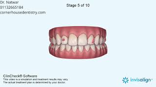 Deep Bite, Maxillary Midline Deviation, Midline Shift, Crowding, Rotations