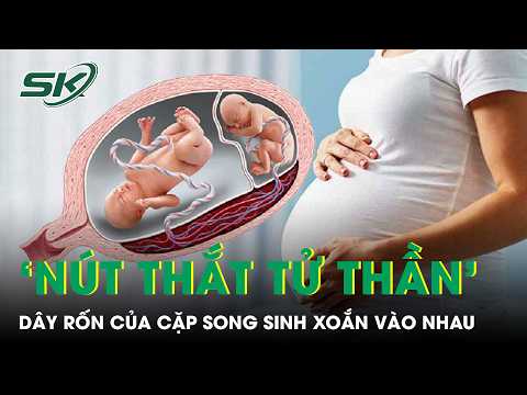 Saving a mother and her twins with umbilical cords tied in a "death knot" in the womb | SKDS
