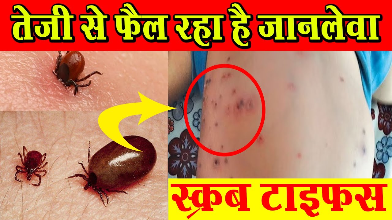 ⁣तेज़ी से फैल रहा है जानलेवा स्क्रब टाइफस, ऐसे पहचाने लक्षण और घरेलू उपाय #scrubtyphus