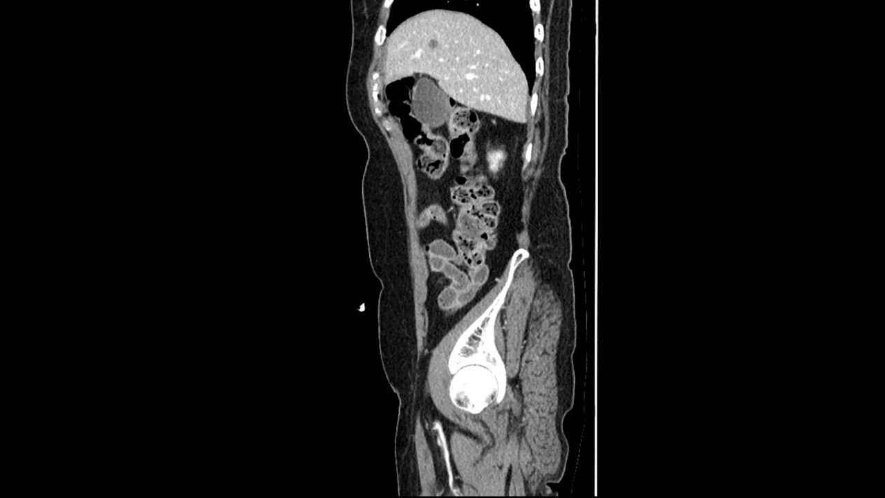 radiolucent GB stone(CT & sono). YouTube