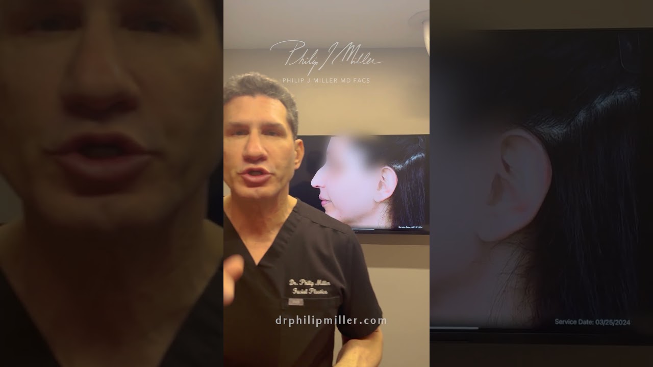 7 Days Post Op Rhinoplasty!