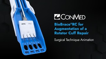 BioBrace®RC for Augmentation of a Rotator Cuff Repair - CONMED Animation