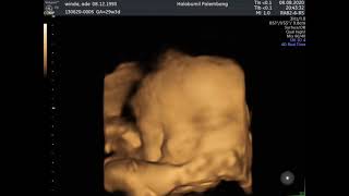 Pergerakan bayi dalam kandungan | USG 4D TERMURAH | Halobumil Palembang