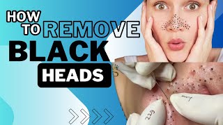 SAY GOODBYE TO BLACKHEADS | HOW TO REMOVE BLACKHEADS