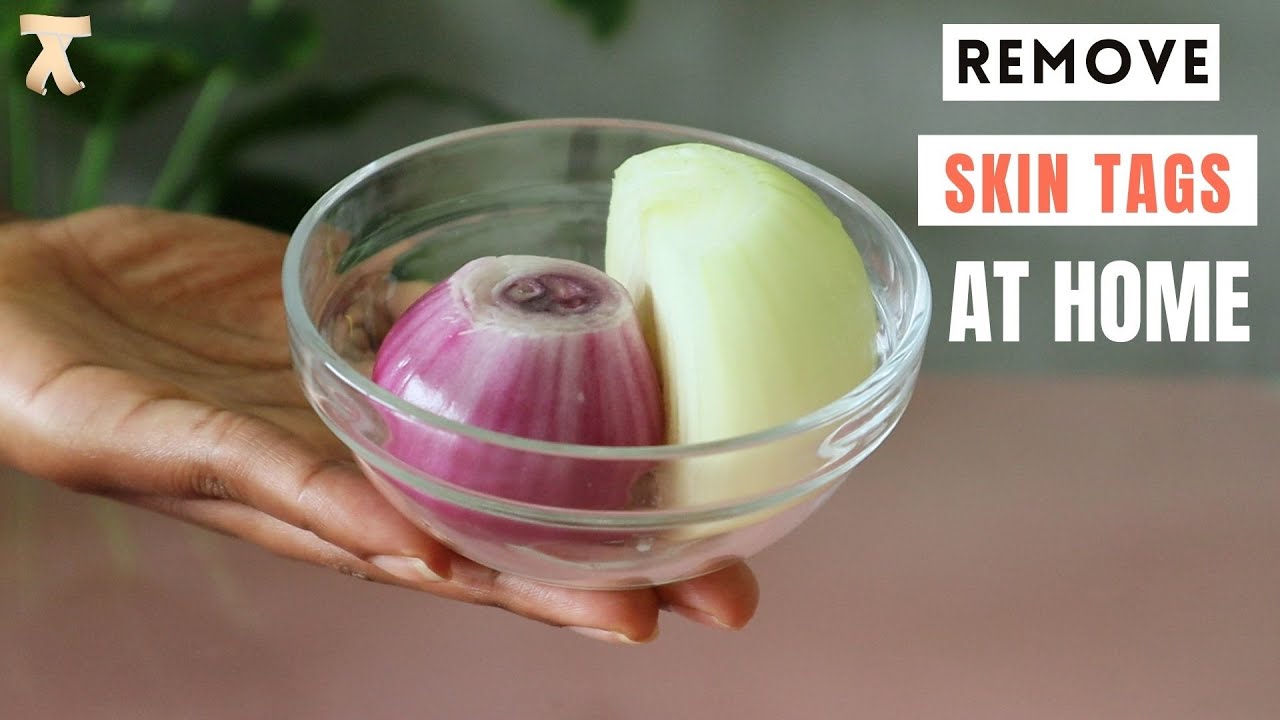REMOVE SKIN TAGS OVERNIGHT / HOW TO REMOVE SKIN TAGS FAST WITH ONION