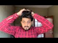 My hair transplant results after 2 years  my hair care routine   hair transplant journey