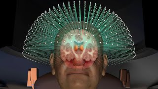 Focused Ultrasound Treatment for Essential Tremor  |  UCSF Neurosurgery