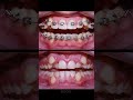 Braces process