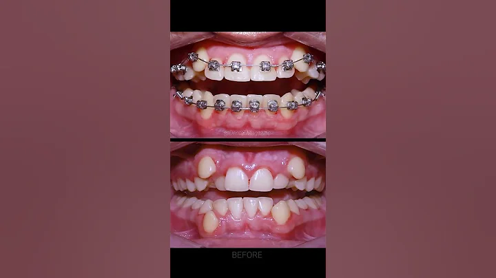 Braces process - DayDayNews