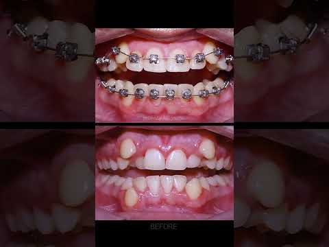 Video: Ko zobu fejas dara ar zobiem?
