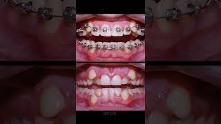 Braces process