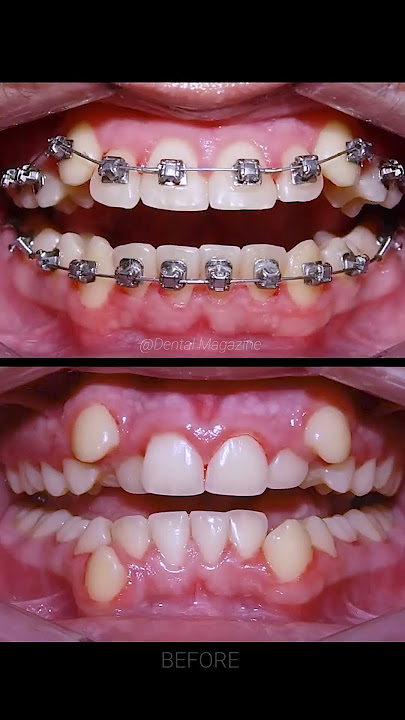 Braces process
