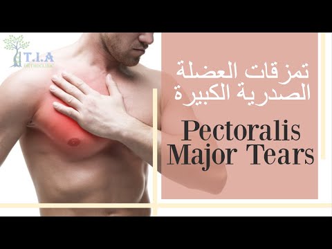 تمزق العضلة الصدرية الكبيرة     pectoralis major tear (subtitled)