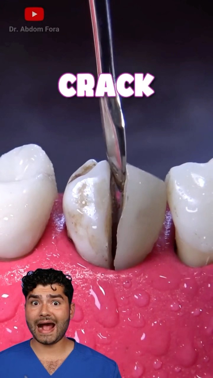 Cracked Tooth !?