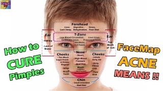 How to Cure Acne on Face mapping with Meanings - 2017 NEW