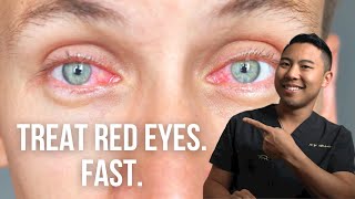 How to get rid of red eyes FAST. | Ophthalmologist @MichaelRChuaMD