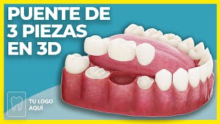 PUENTE DE 3 PIEZAS 🦷 Vídeos dentales 3D - Pedagogía de pacientes de Clínica Dental - Odontología 3D