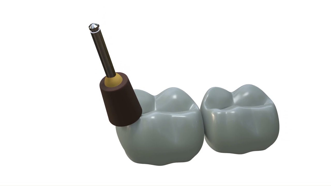 Intraoral ceramic polishing