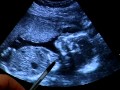 Ультразвукове обстеження вагітних жінок