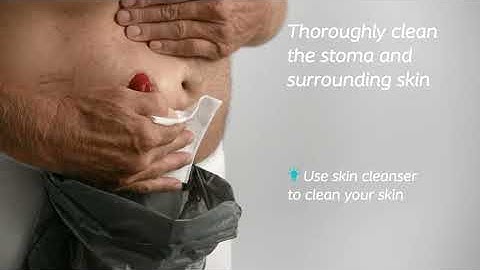 SenSura® Mio Urostomy 1 piece (How to Use Video)