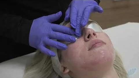 (Re)ignite a bright, even skin tone with Intense Pulsed Light (IPL)