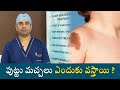 Why Do We Have Birthmarks | పుట్టు మచ్చలు ఎందుకు వస్తాయి ?