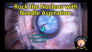 Rock the nucleus with intumescent white cataract needle aspiration