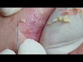 |270| Best compilation of blackheads in June 2020 - Những ca mụn hay nhất tháng 6 năm 2020