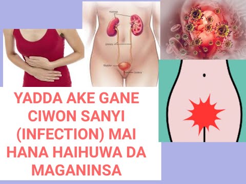 Yadda ake gano sanyi mai Hana haihuwa da yadda akeyin maganinsa cikin sauki